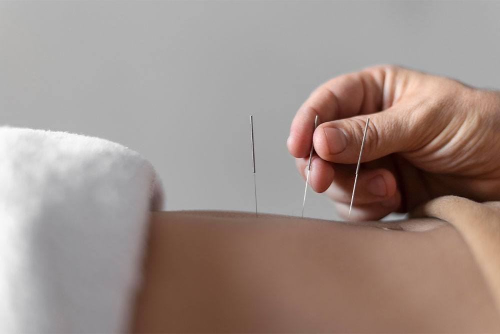dry needling acupuncture physiotherapy penang